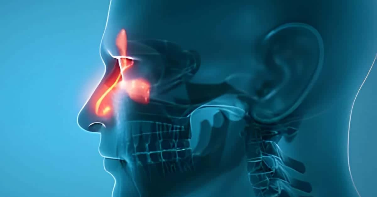 Are sinus infections contagious a comprehensive guide