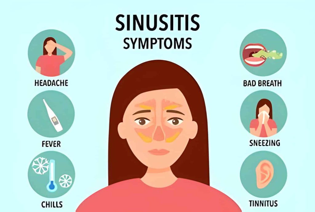 Are sinus infections contagious a comprehensive guide